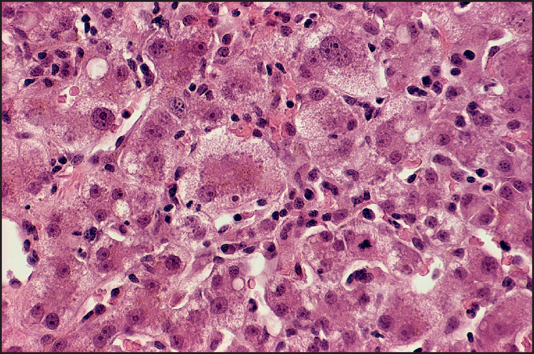 Figure 6.3, Classic acute hepatitis. Swollen hepatocytes are present, together with a mononuclear infiltrate in the sinusoids. Disarray of the plate architecture is caused by loss of hepatocytes. (H&E stain.)