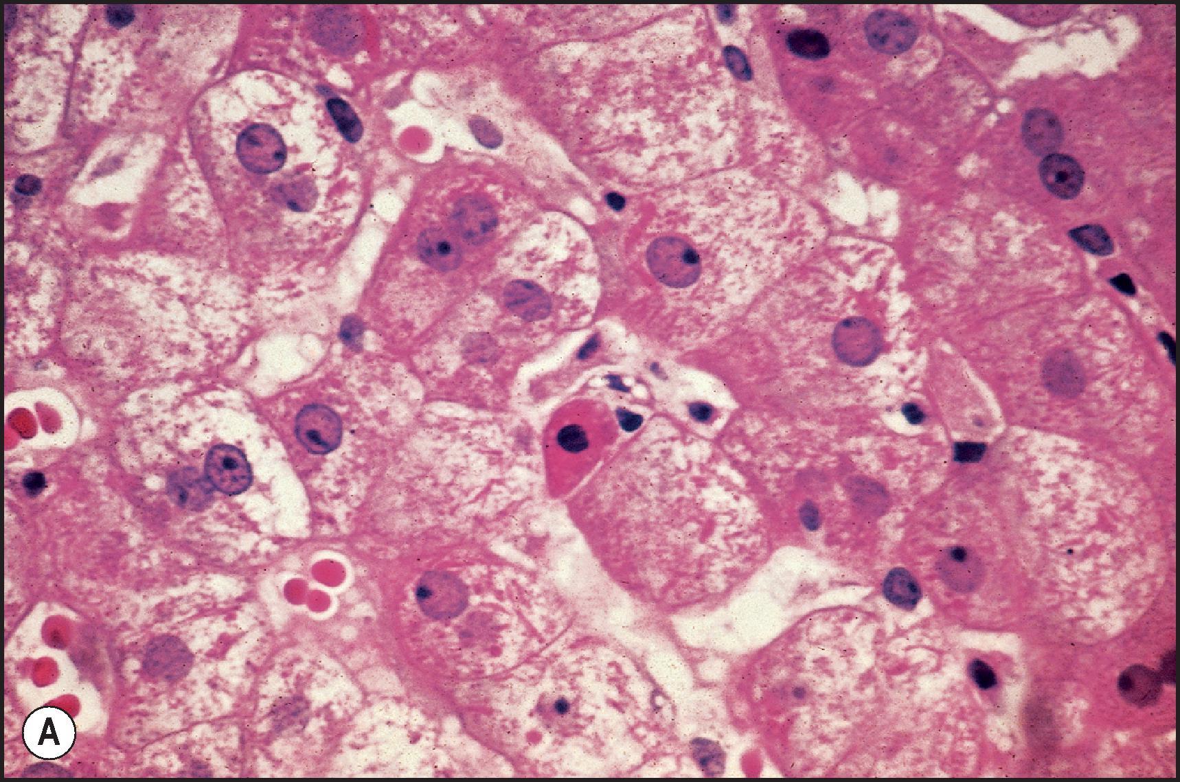 Figure 6.4, (A) Classic acute hepatitis. Focal apoptosis of hepatocyte with nuclear remnant present. Inflammatory cells are present next to the apoptotic cell within the sinusoid. Hepatocyte swelling is also present. (B) Classic acute hepatitis. Focal apoptosis of hepatocytes is present (rounded acidophil body), as well as inflammation of the lobule and disarray of the plate architecture. (H&E stain.)