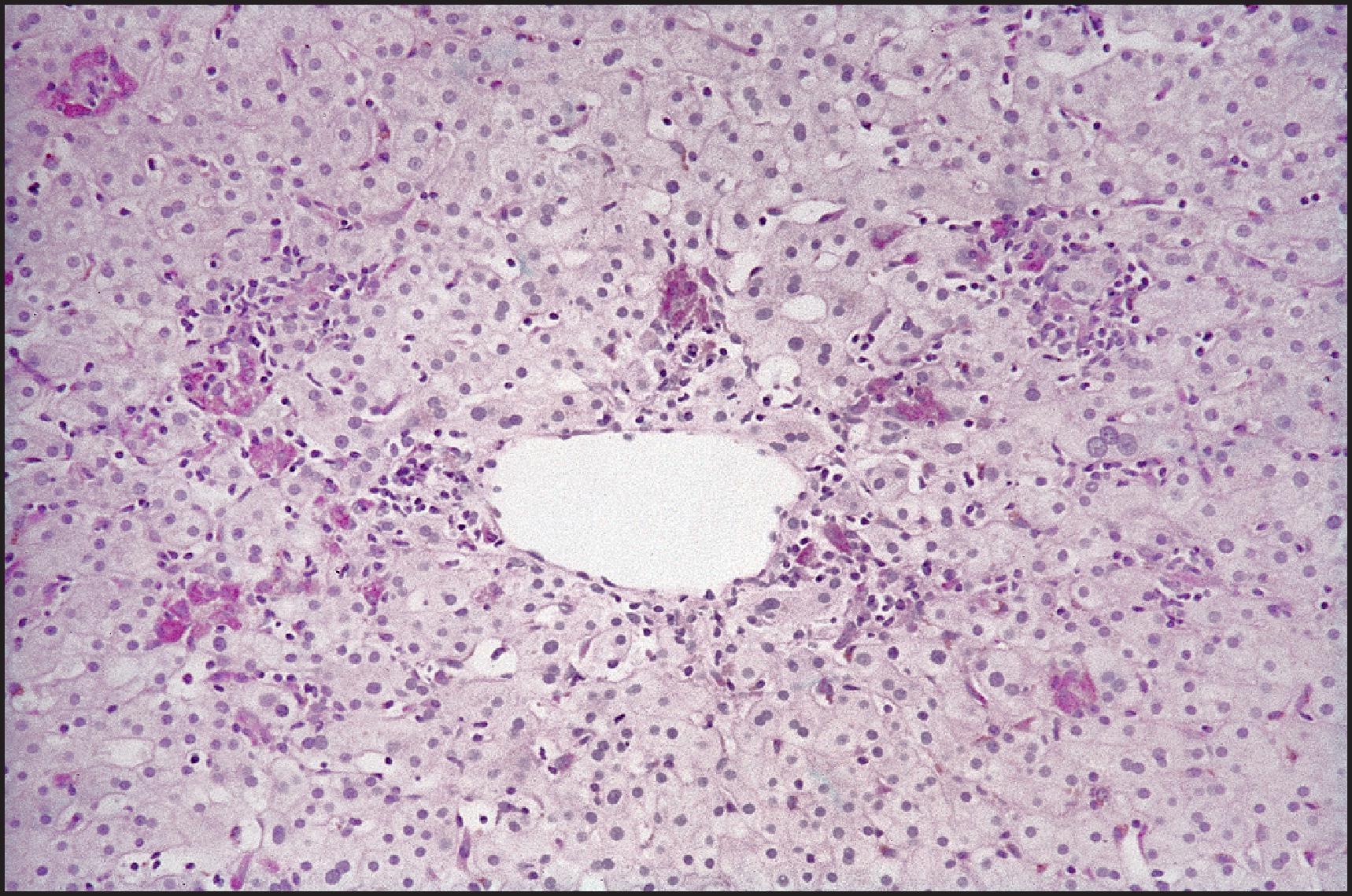 Figure 6.5, Classic acute hepatitis. Clumps of hypertrophied Kupffer cells are most prominently seen near the centrizonal region and stain strongly with periodic acid-Schiff (PAS) after diastase digestion.