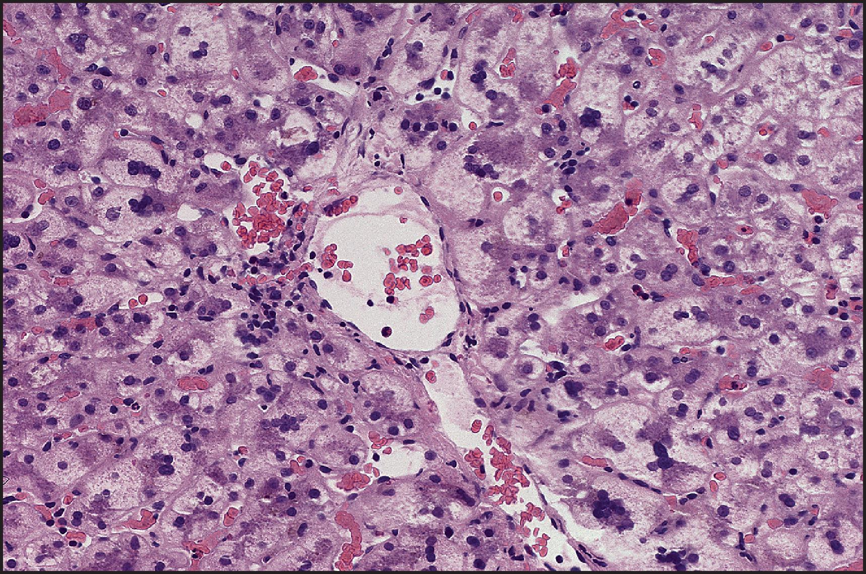 Figure 6.6, Giant cell change of hepatocytes in an adult. Many of the hepatocytes in the centrizonal area contain large numbers of nuclei. (H&E stain.)