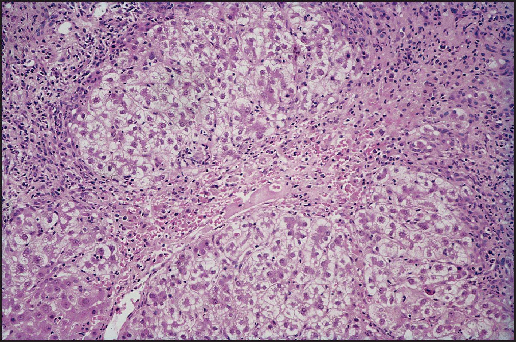 Figure 6.7, Acute hepatitis with bridging necrosis. Curving bridges are formed as a result of confluent necrosis linking central and portal zones. (H&E stain.)