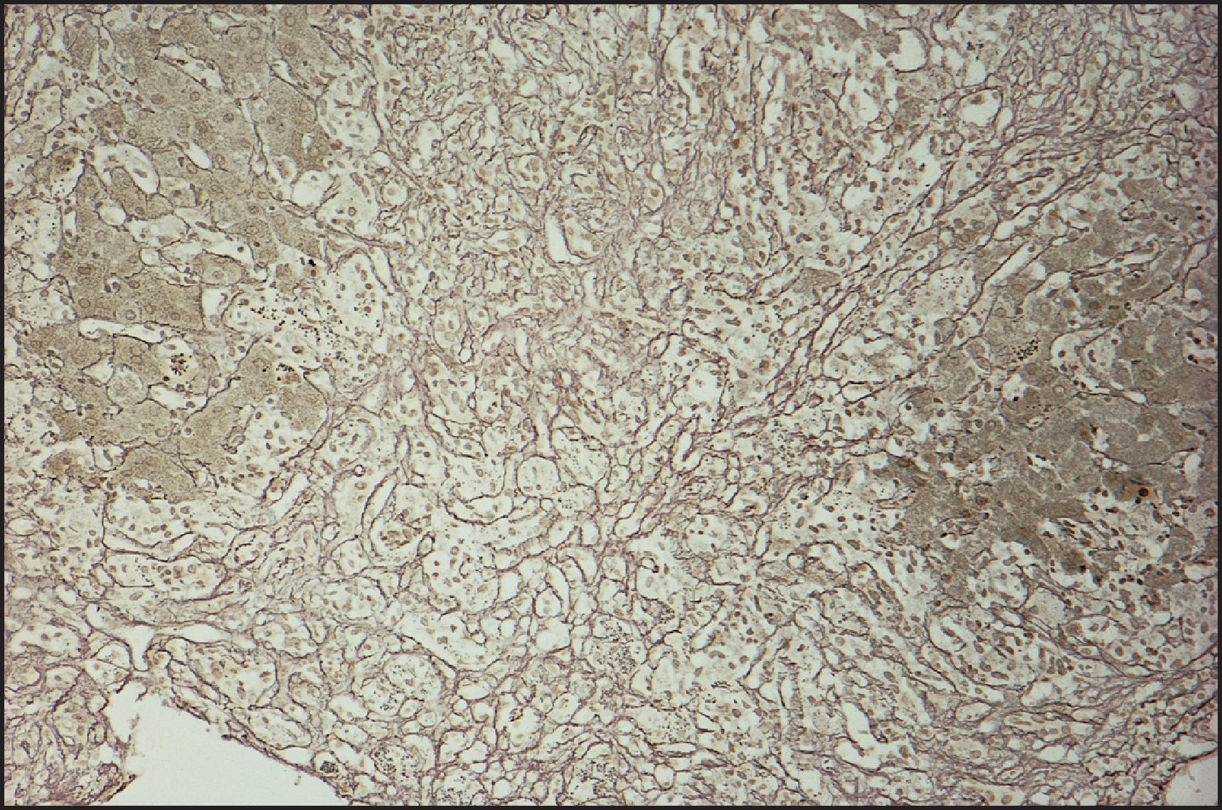 Figure 6.8, Acute hepatitis with bridging necrosis. The reticulin framework remains intact and has not significantly collapsed at this point. (Reticulin stain.)