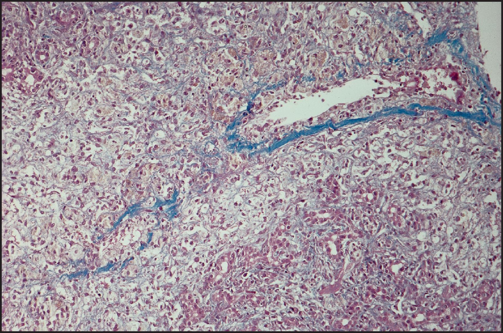 Figure 6.9, Acute hepatitis with bridging necrosis. The centrizonal region shows large numbers of macrophages that stain light blue to grey. The wall of the vein, in contrast, is bright blue and lined by dense collagen bundles. (Trichrome stain.)