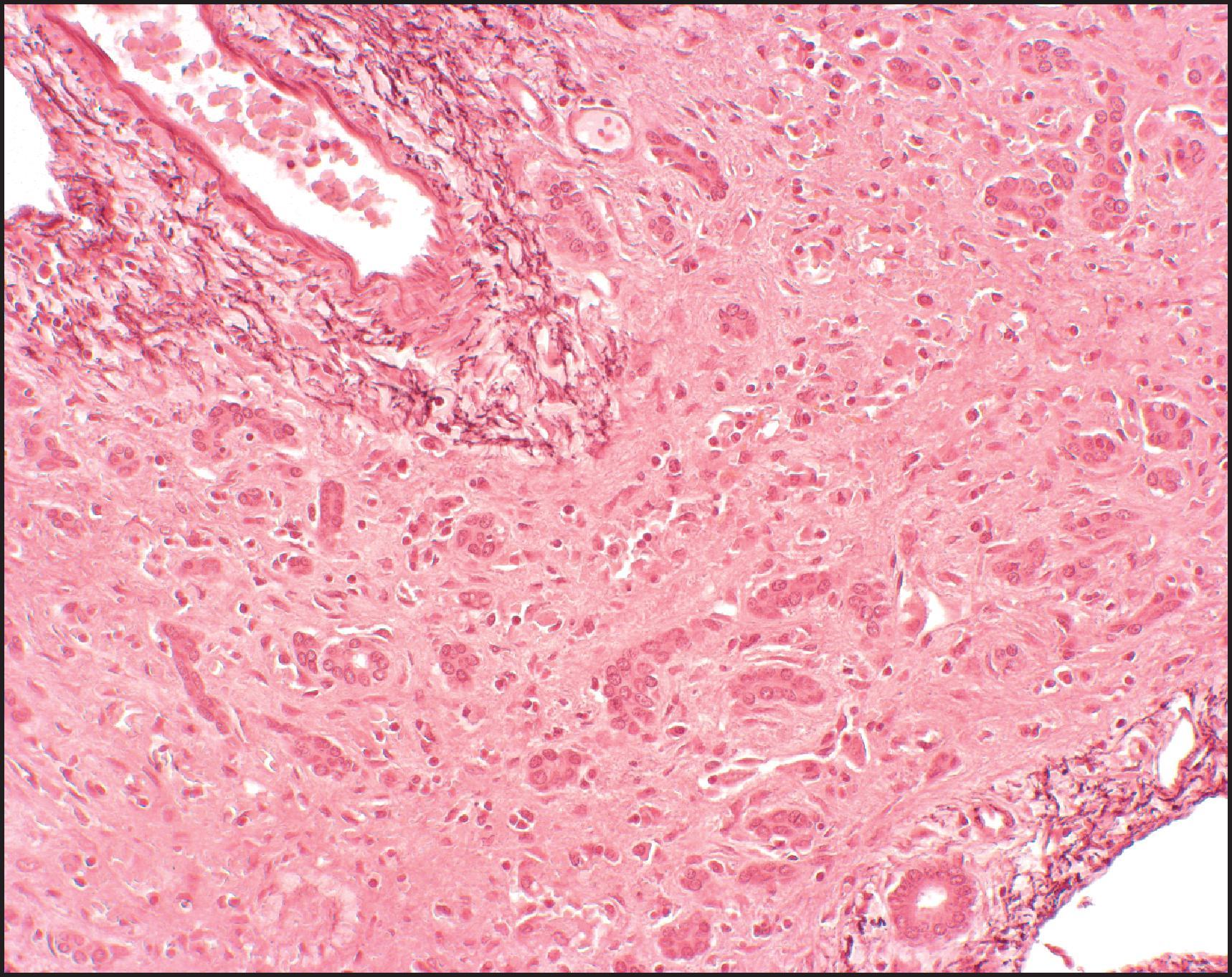 Figure 6.10, Acute hepatitis with bridging necrosis. Deeply stained elastic fibres are present in the portal tract. Adjacent areas of collapse have no elastic tissue. (Orcein stain.)