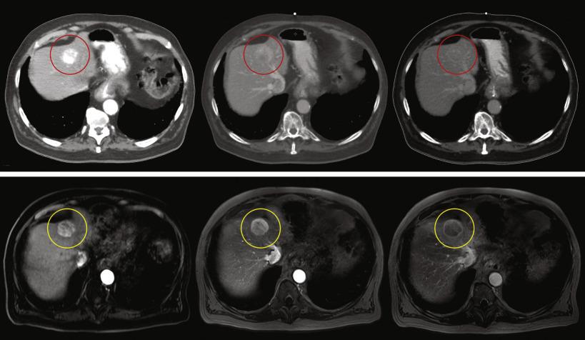 Fig. 56.1, Arterial, venous, and delayed/equilibrium phase sequences on computed tomography (CT) scan (upper) and magnetic resonance imaging (MRI, lower ). A heterogeneous mass (red circle on CT and yellow circle on MRI) in Segment 2 demonstrates arterial enhancement, venous washout, and capsule meeting criteria for LI-RADS (Liver Imaging Reporting and Data System) 5. LI-RADS 5 is considered “definitely hepatocellular carcinoma” and is used when imaging criteria are unequivocal and sufficient to render a diagnosis without biopsy. 36