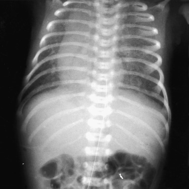 Figure 5.1, Abdominal radiograph demonstrating a midline liver in heterotaxy syndrome.