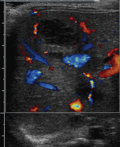 Figure 5.11, E. coli abscess in a 3-week-old with sepsis. A transverse color Doppler ultrasound image through the right hepatic lobe shows a complex, septated cystic lesion with intense peripheral vascularity and no blood flow centrally.