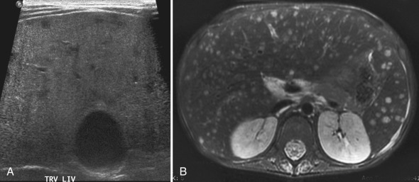 Figure 5.12, Hepatic Candida microabscesses in a 5-year-old with leukemia with fever and neutropenia.