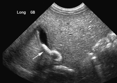 Figure 5.13, Ascariasis of the biliary tree in a 2-year-old with recurrent right upper quadrant pain and jaundice. A transverse ultrasound image at the level of the gallbladder shows a linear echogenic worm in the cystic duct ( arrow ).