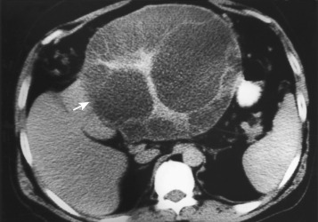 Figure 5.14, An axial computed tomography image shows a liver abscess ( arrow ) in a child with Echinococcus infection. A large, complex cystic lesion is seen, with multiple daughter cysts noted.