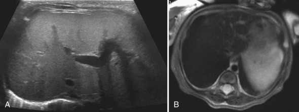 Figure 5.15, Primary hemochromatosis in a 6-week-old infant with cholestasis and hepatitis.