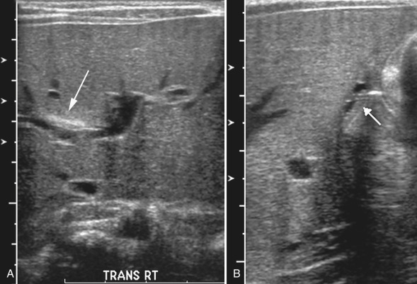 Figure 5.3, Two-month-old with biliary atresia.