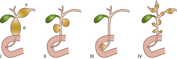 Figure 5.5, Classification of choledochal cysts.