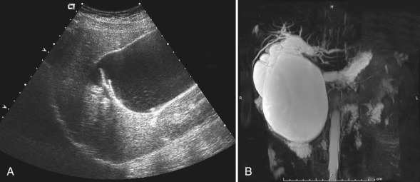 Figure 5.6, Choledochal cyst in a 16-year-old with upper abdominal pain and a palpable mass.