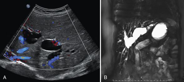 Figure 5.7, Caroli disease in a 9-year-old with cholestasis and autosomal recessive polycystic kidney disease.