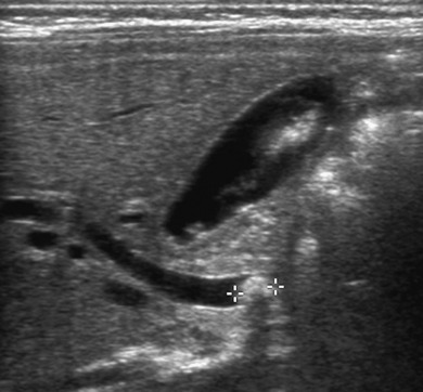 Figure 5.8, Tumefactive bile sludge in a 15-day-old infant with rapidly rising total bilirubin levels. A sagittal ultrasound image shows biliary sludge floating in the gallbladder lumen, with an obstructing sludge ball in a dilated common bile duct ( cursors ).