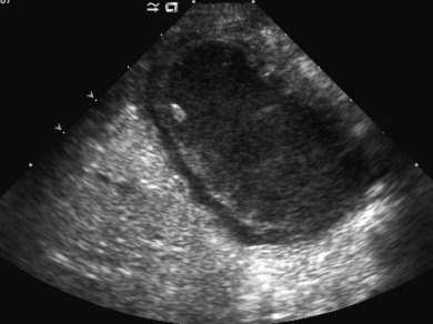 Figure 5.9, Acute acalculous cholecystitis in a 9-month-old infant with urosepsis. A transverse ultrasound image of the gallbladder shows a dilated, debris-filled, thick-walled gallbladder.