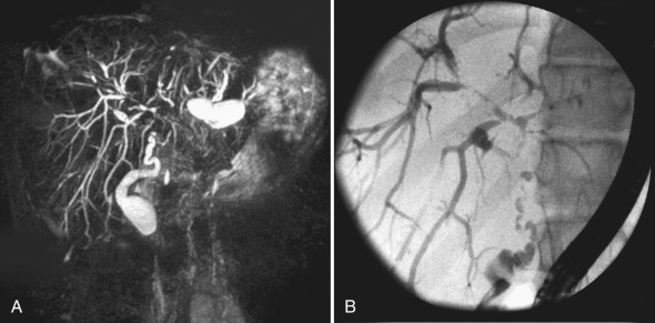 Figure 5.10, Primary sclerosing cholangitis in a 15-year-old with Crohn disease and acute abdominal pain. A, Magnetic resonance cholangiopancreatography shows irregular beading of the intrahepatic ducts. B, An oblique image from an endoscopic retrograde cholangiopancreatography confirms narrowing and irregular beading of multiple hepatic ducts.