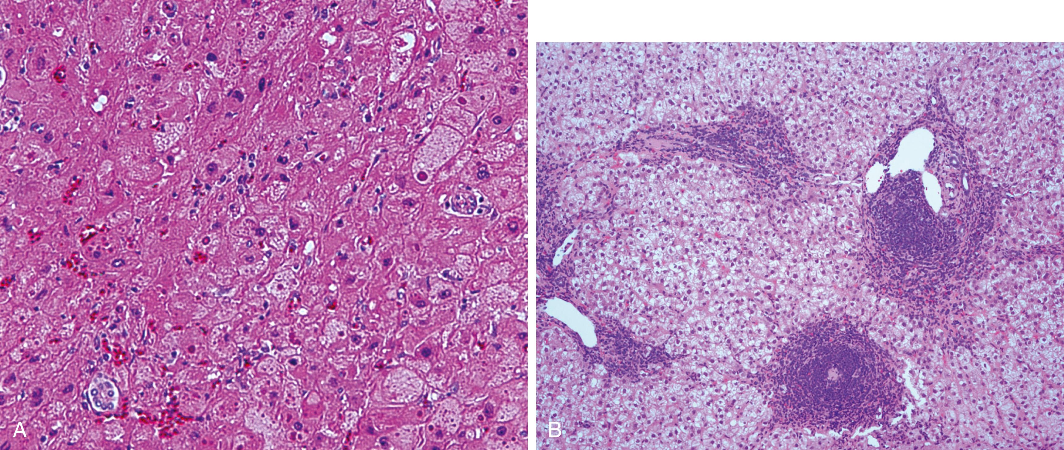 Figure 7.1, A, Ground-glass hepatocytes in hepatitis B. B, Chronic hepatitis C. Classic lymphoid aggregates with focal mild interface hepatitis.