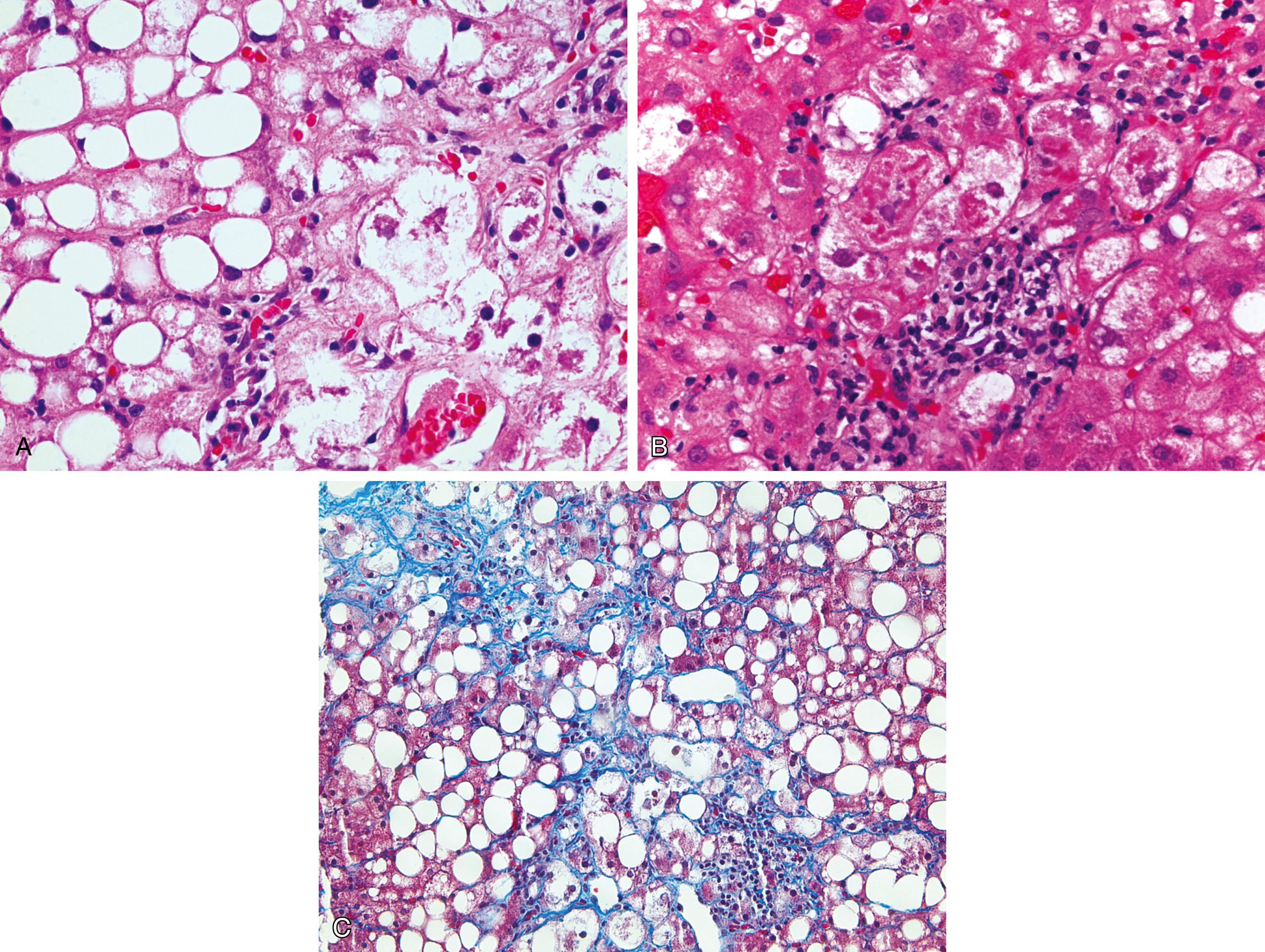 Figure 7.3, Steatohepatitis.