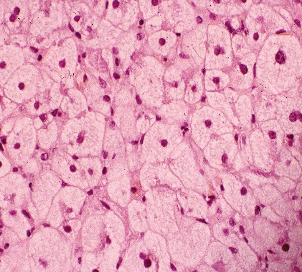 Figure 7.4, Acute fatty liver of pregnancy.