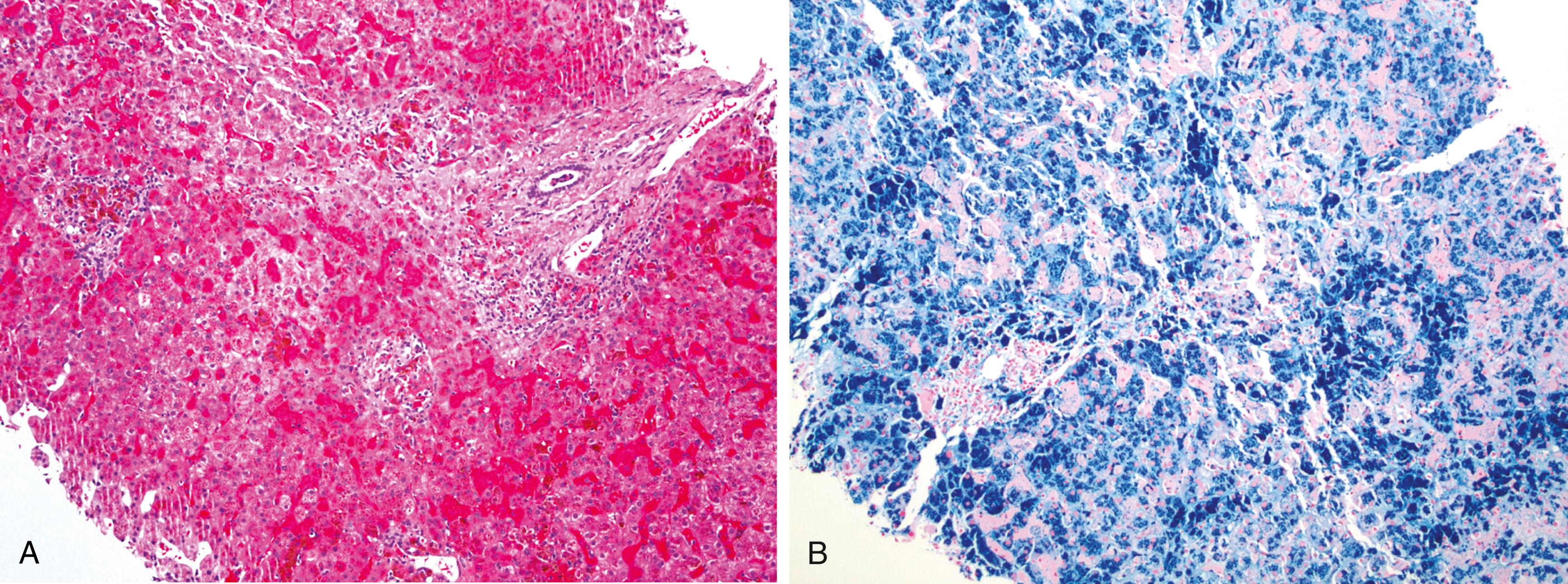 Figure 7.5, Hemochromatosis.