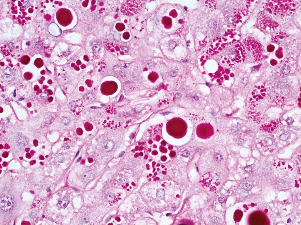 Figure 7.7, α 1 -Antitrypsin deficiency.