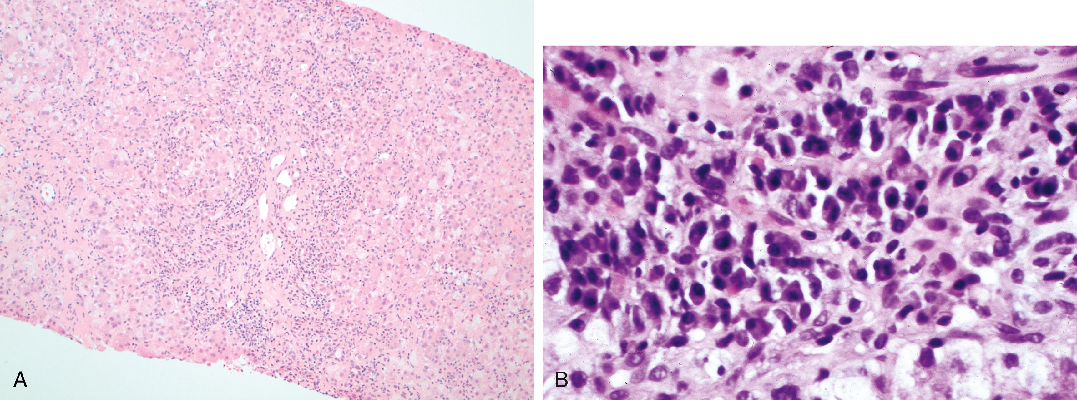 Figure 7.8, Autoimmune hepatitis.