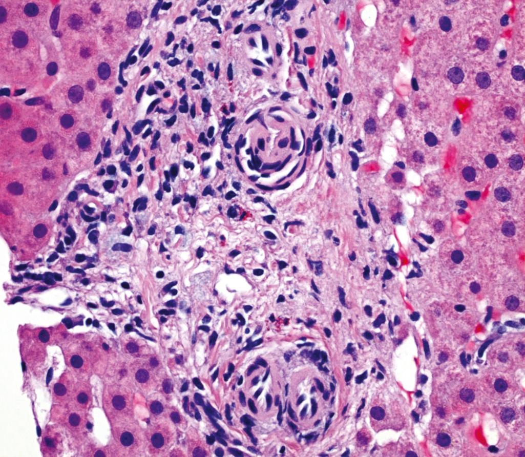 Figure 7.9, Primary biliary cholangitis.