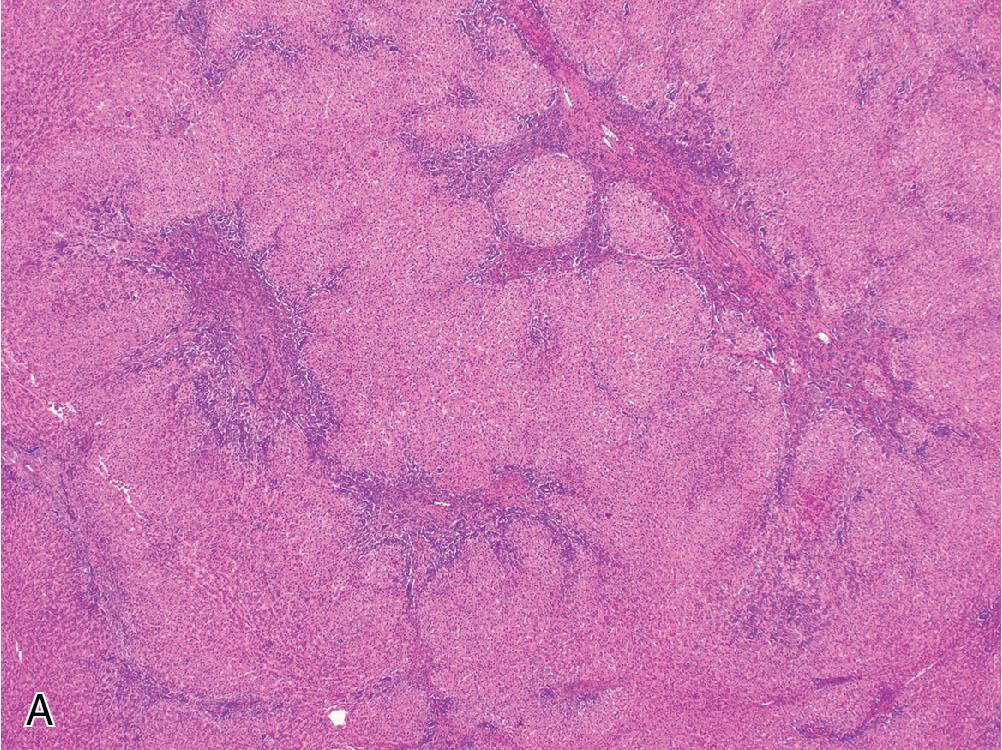 Fig. 4.1, Focal nodular hyperplasia. A, Bands of fibrosis radiate from a larger central scar and impart a nodular appearance at low power. B, Prominent ductular reaction is seen along the fibrous bands.