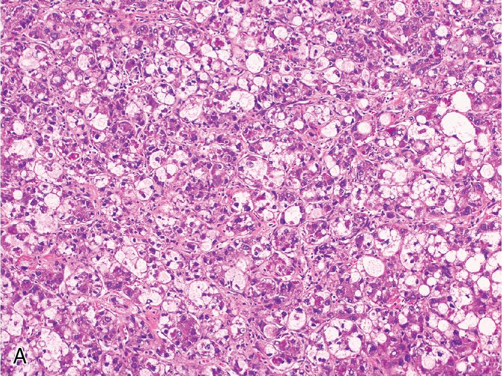 Fig. 4.12, The steatohepatitic variant of hepatocellular carcinoma recapitulates the ballooning degeneration, Mallory hyaline, and pericellular fibrosis characteristic of steatohepatitis ( A ), but shows striking cytologic atypia when compared with background hepatocytes ( B ).