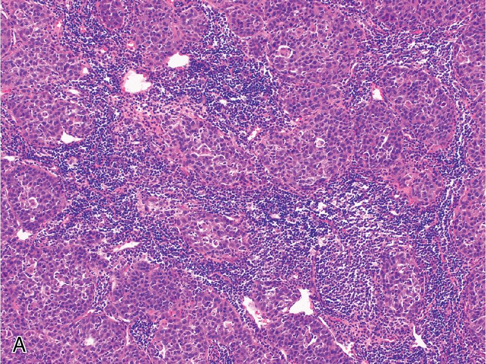 Fig. 4.13, The lymphocyte-rich variant of hepatocellular carcinoma is a rare subtype that may be mistaken for lymphoma. ( A ) 100x. ( B ) 200x.