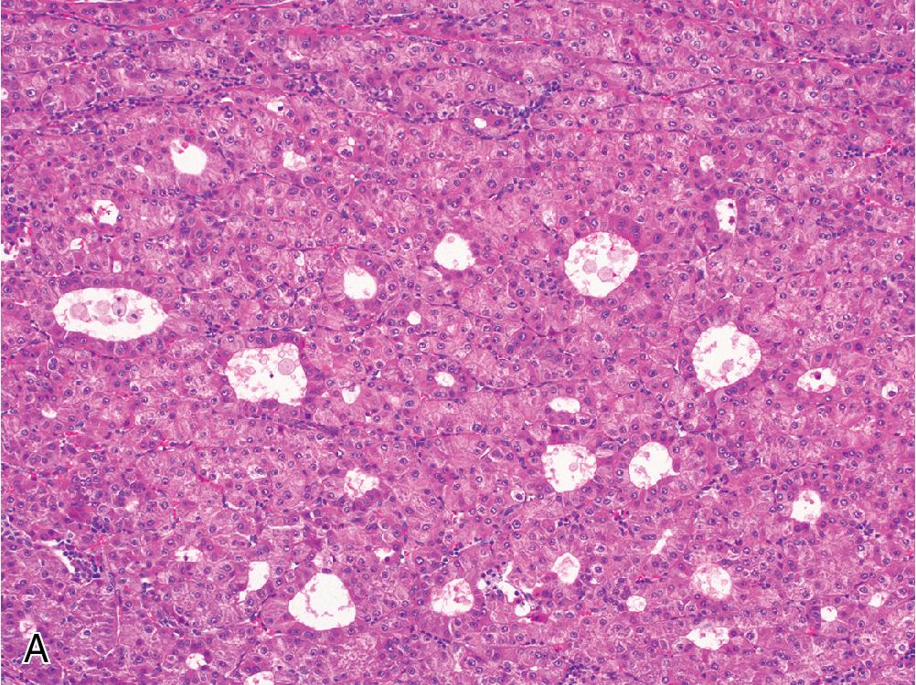 Fig. 4.14, Immunohistochemistry often shows differential sensitivity in well-differentiated and poorly differentiated hepatocellular carcinoma (HCC). In well-differentiated HCC ( A, H&E; B, reticulin), glypican-3 is typically a poor marker ( C ), but arginase and HepPar1 ( D ) frequently show diffuse expression. However, in poorly differentiated HCC ( E, H&E; F, reticulin), glypican-3 may be extremely helpful ( G ), while arginase and HepPar1 ( H ) are less reliable than in more well-differentiated HCC.