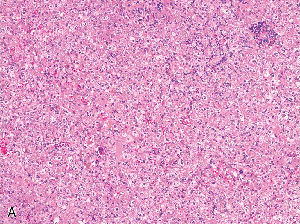 Fig. 4.15, Hepatoblastoma, fetal pattern. (A) Tumor cells resemble immature hepatocytes, arranged in thin trabeculae or sheets with extramedullary hematopoiesis. (B) Variably eosinophilic cytoplasm imparts an alternating light and dark appearance at low power.