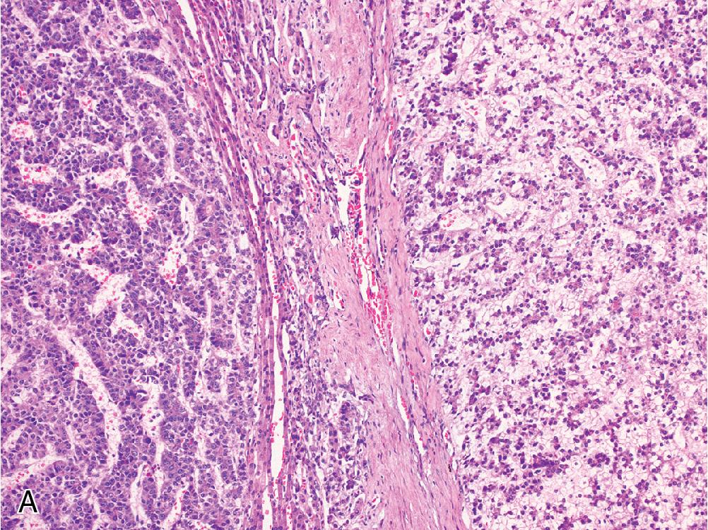 Fig. 4.16, Hepatoblastoma, embryonal pattern. Compared with the fetal pattern ( A, right), the embryonal morphology ( A , left) consists of smaller, hyperchromatic tumor cells, characterized by a higher nucleus-to-cytoplasm ratio ( B ).