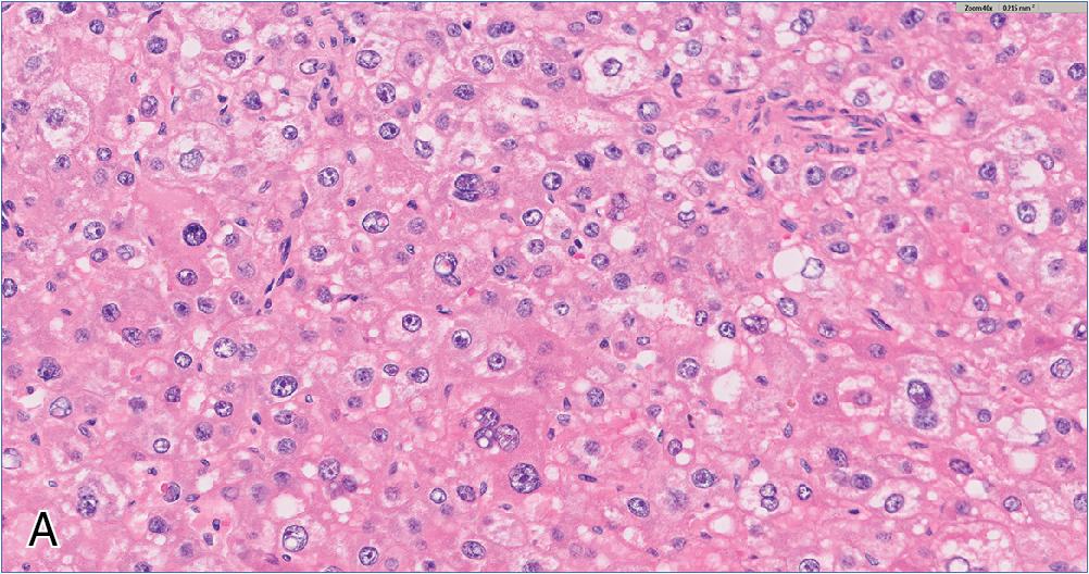 Fig. 4.17, Hepatoblastoma, pleomorphic and macrotrabecular patterns. Both patterns are uncommon variants that may resemble adult hepatocellular carcinoma. The pleomorphic pattern ( A ) exhibits more pronounced nuclear size variance than fetal or embryonal patterns, and the macrotrabecular pattern ( B ) features prominently widened trabeculae often seen in more poorly differentiated hepatocellular carcinomas. As with other rare hepatoblastoma subtypes, however, these are often admixed with more recognizable forms.