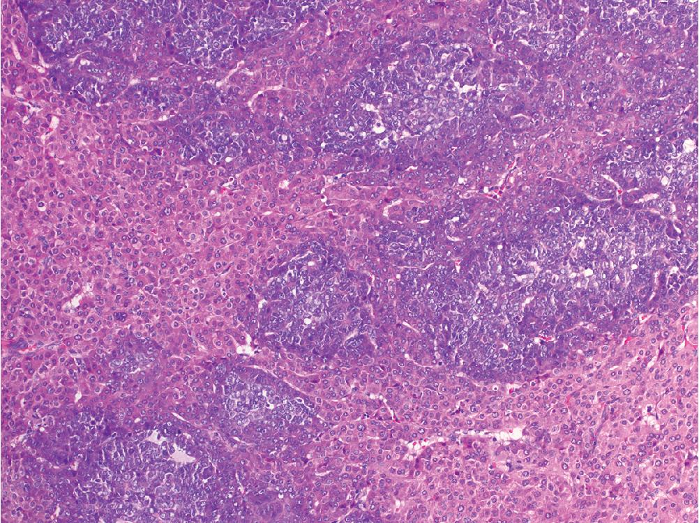 Fig. 4.18, Hepatoblastoma, small undifferentiated pattern. This variant is rarely seen and describes a tumor with aggregates of “small round blue cells” that shares a non-specific and undifferentiated morphology with several other pediatric tumors. The presence of intermixed fetal morphology helps with diagnosis in this case.