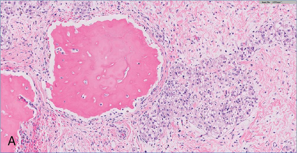 Fig. 4.19, Hepatoblastoma, mixed epithelial-mesenchymal pattern. About 30% of hepatoblastomas contain a mixture of epithelial subtypes such as fetal ( A ) or embryonal ( B ) with various mesenchymal components, commonly osteoid.