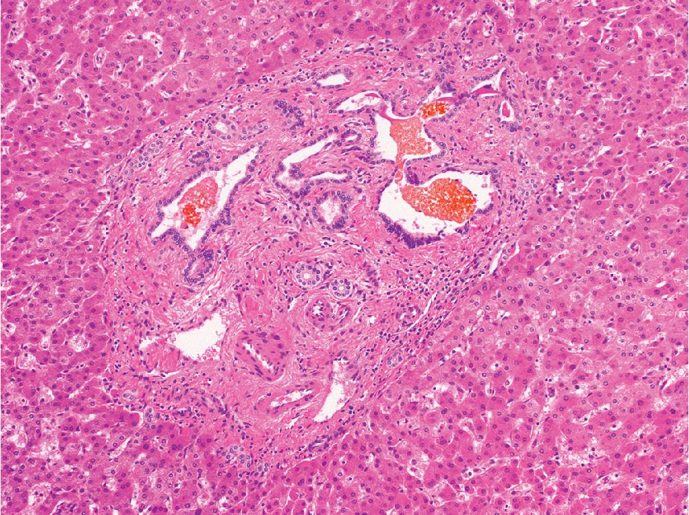 Fig. 4.20, Bile duct hamartoma. Lesions are found near portal tracts and are characterized by dilated, irregularly shaped bile ductules within dense fibrous stroma. The lumen often contains bile or proteinaceous debris, but not mucin.