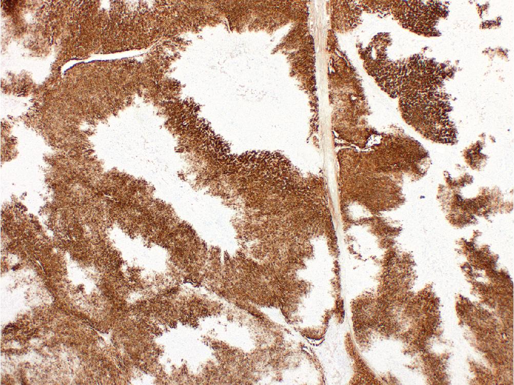 Fig. 4.2, Focal nodular hyperplasia. Immunohistochemistry for glutamine synthetase demonstrates a characteristic geographic or map-like pattern of staining at low power.