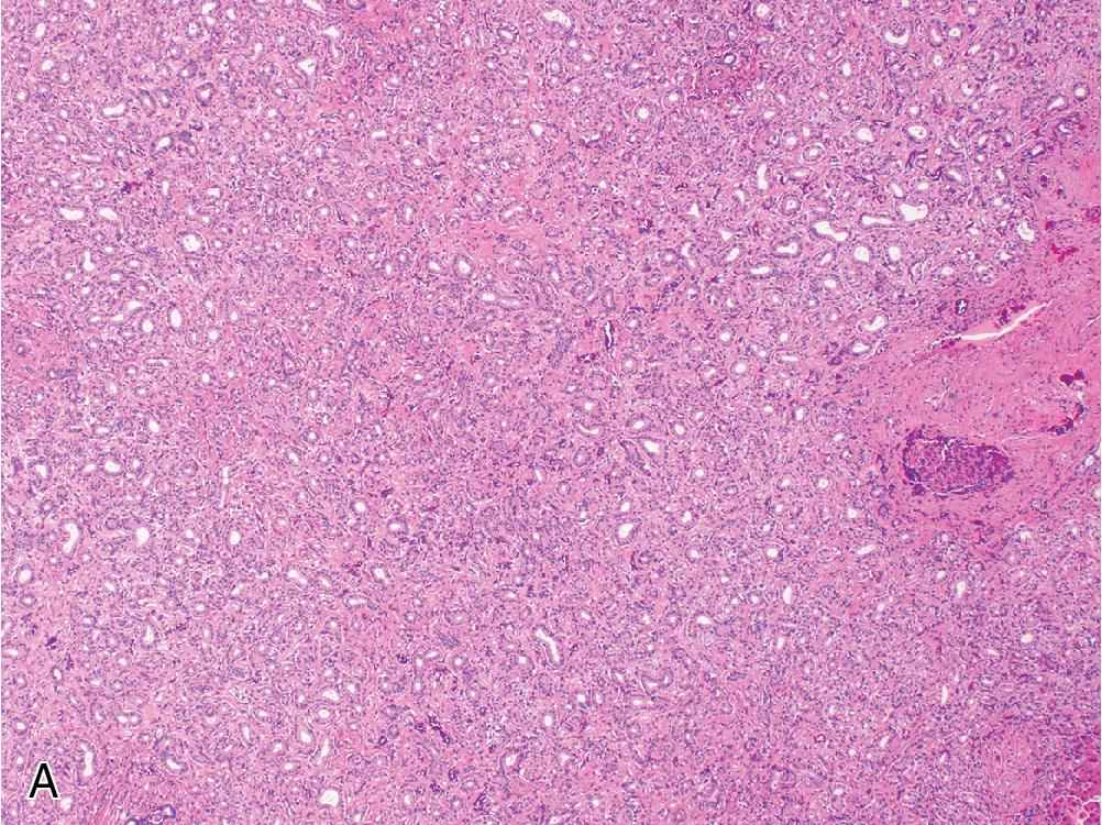 Fig. 4.21, Bile duct adenoma consists of small tubules with relatively uniform cytology and gland spacing set within fibrous stroma. ( A ) 40×. ( B ) 100×.