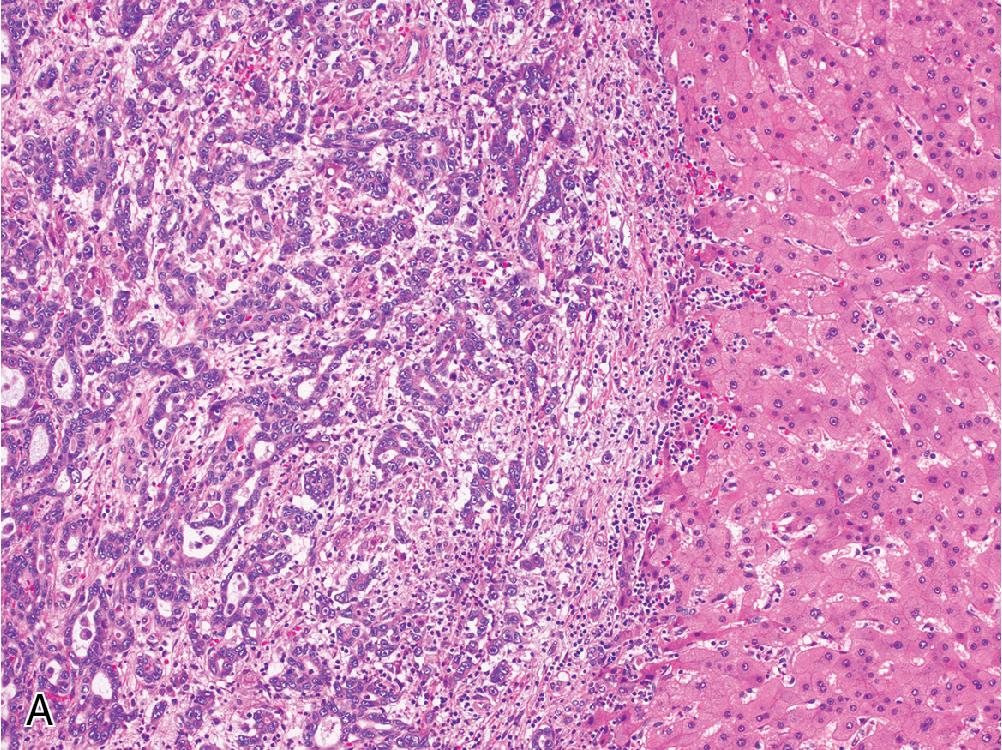 Fig. 4.22, Compared with cholangiocarcinoma ( A ), a bile duct adenoma ( B ) contains less cytologic atypia and mitotic activity. These entities can often be distinguished by Ki-67 index, which is generally high in cholangiocarcinoma ( C ) but always less than 10% in adenomas ( D ). In addition, p53 is often aberrant in cholangiocarcinoma ( E ) but shows wild-type expression in adenomas ( F ).