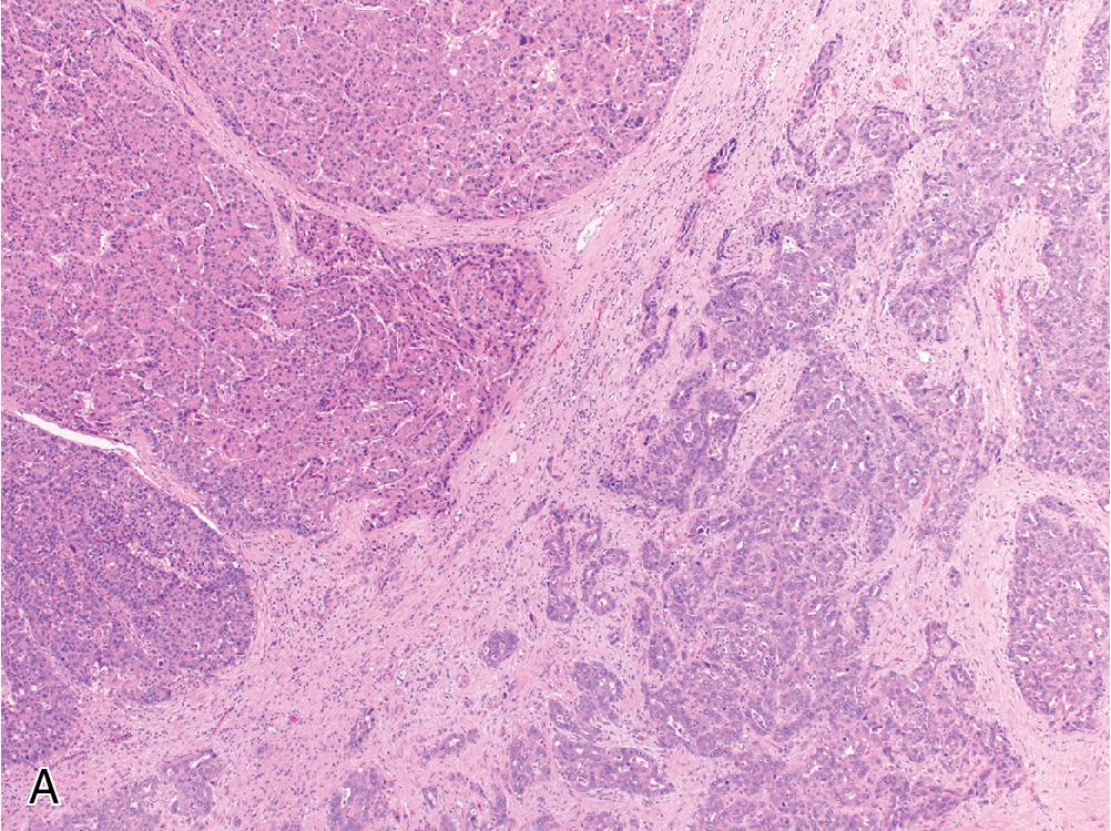 Fig. 4.24, Combined hepatocellular-cholangiocarcinoma. A, This biphasic tumor contains two distinct morphologic patterns that resemble intermixed elements of hepatocellular carcinoma and adenocarcinoma. Immunohistochemistry for CK19 ( B ) will highlight the cholangiocarcinoma component, while arginase ( C ) will only stain the areas of hepatocellular carcinoma.