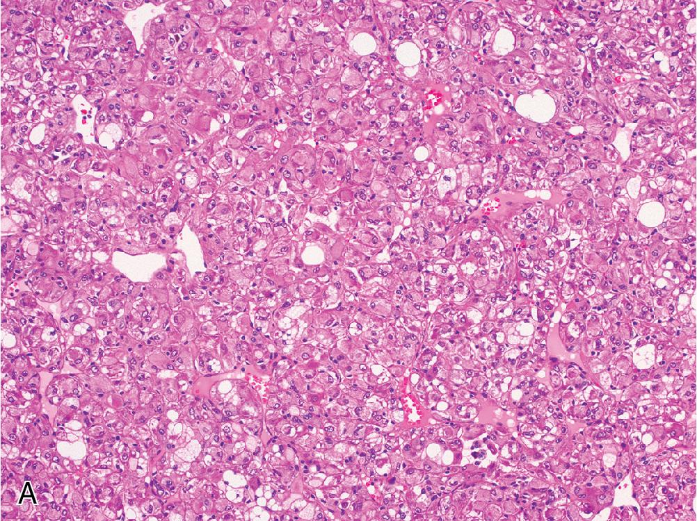 Fig. 4.25, Hepatic angiomyolipomas with a prominent epithelioid component can look hepatoid ( A ). These can be easily misdiagnosed as hepatocellular carcinoma. However, immunohistochemistry for arginase will be negative ( B ), and melanomyoid markers like HMB-45 ( C ) will stain the epithelioid component.