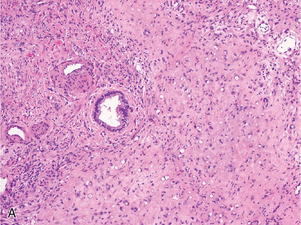 Fig. 4.26, Epithelioid hemangioendothelioma tends to entrap native liver structures such as hepatocytes or portal zones ( A ) and is characterized by “blister cells,” epithelioid tumor cells with intracellular capillary lumen that may contain red blood cells ( B ). There is no mucin. Immunohistochemistry for ERG ( C ) and CAMTA1 ( D ) are strongly positive in tumor cells.