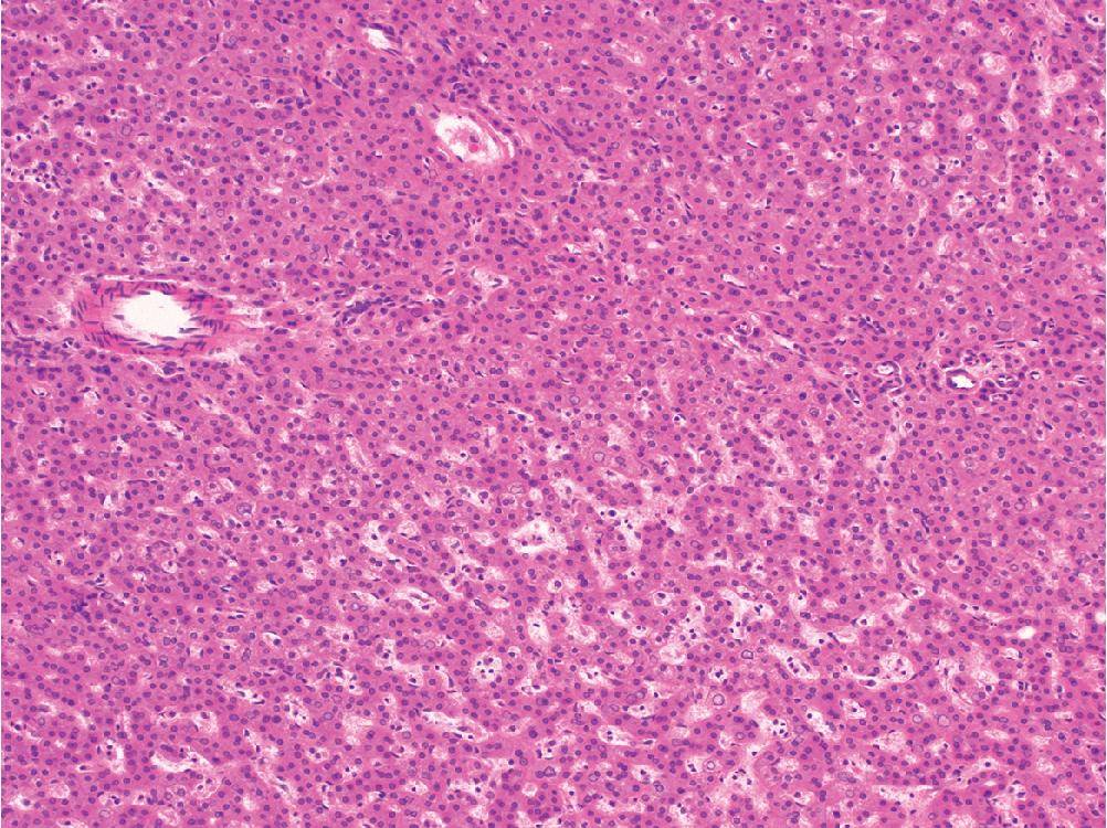 Fig. 4.3, Hepatocellular adenoma. Typical appearance of an adenoma, with scattered unpaired arterioles in a background of normal hepatocytes arranged in trabecular plates of normal width (1–2 across).