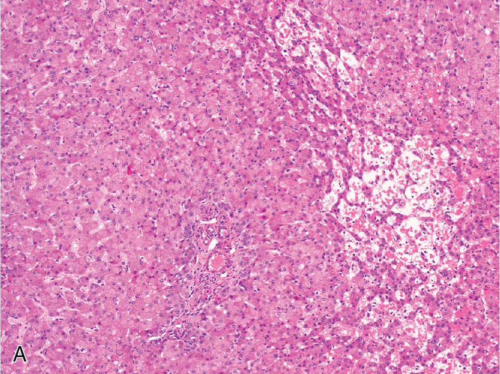 Fig. 4.4, Hepatocellular adenoma, inflammatory type. A, In addition to unpaired arterioles, inflammatory adenomas often show patchy sinusoidal dilatation with congestion and chronic inflammation. Compared with the background liver parenchyma ( B and C, right), inflammatory adenomas often demonstrate increased staining for CRP ( B and C, left) and SAA.