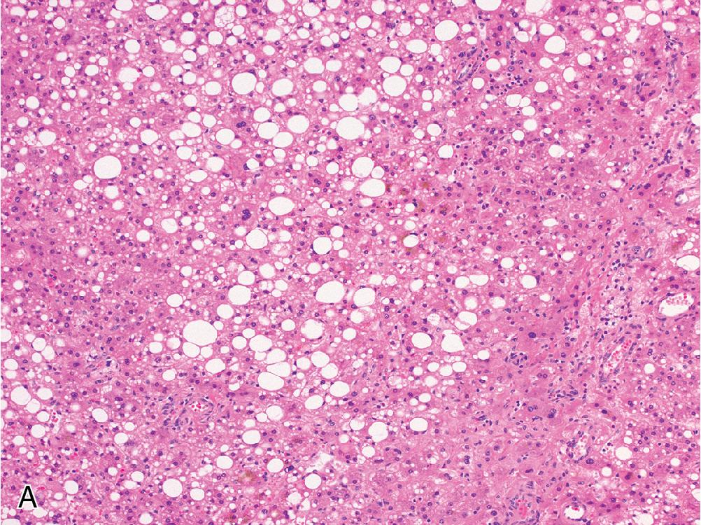 Fig. 4.5, Hepatocellular adenoma, HFN1α-inactivated type. A, These adenomas often contain bland macrosteatosis. The interface between the adenoma and background liver ( B ) highlights the characteristic loss of LFABP expression ( C, right), which is preserved in the background liver ( C, left).