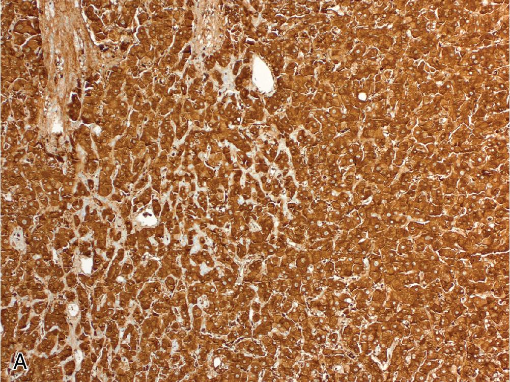 Fig. 4.6, Hepatocellular adenoma, β-catenin–activated type. These adenomas are morphologically variable but characterized by diffuse glutamine synthetase expression, which is a sensitive marker for β-catenin activation. A, Diffuse, homogenous expression is defined by staining of >90% of tumor cells and is strongly linked to β-catenin activation. B, Diffuse heterogenous expression describes adenomas in which 50% to 90% of the tumor express GS and shows a weaker correlation with β-catenin activation.