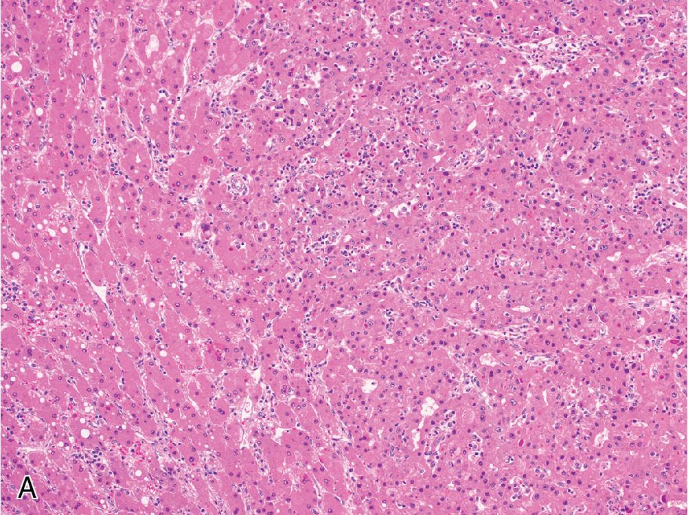 Fig. 4.7, Malignant transformation within inflammatory-type hepatocellular adenoma. H&E staining (A) demonstrates the transition from relatively normal-appearing hepatocytes arranged in thin trabeculae to a more disordered arrangement of hepatocytes with increased cytoarchitectural atypia and profound loss of reticulin framework (B) . CRP immunohistochemistry is diffusely positive in the adenoma (C) and is increased compared with the background parenchyma.